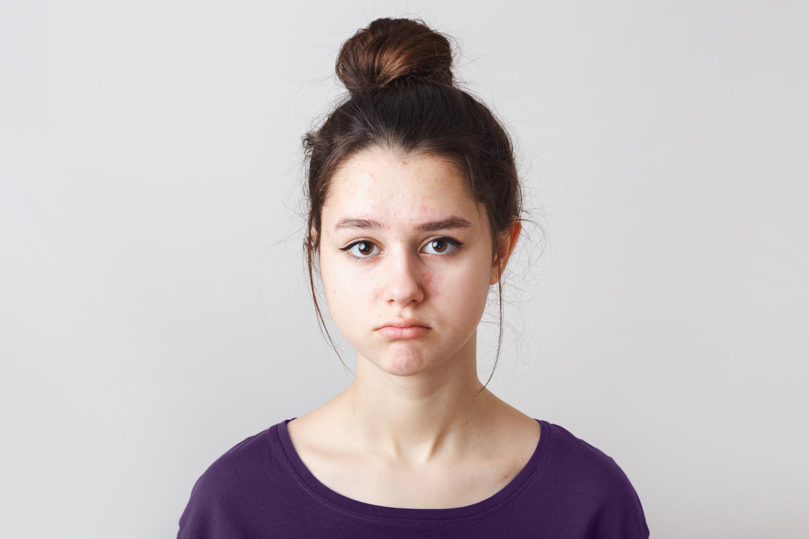 Mujer joven con acné en el rostro. Cara disgustada.
