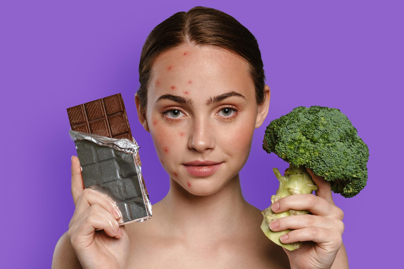 Mujer joven con acné en el rostro. En una mano toma un chocolate y en la otra un brócoli.
