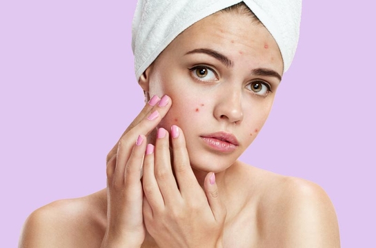  Mujer joven con acné en el rostro. Tiene una toalla de baño en la cabeza.